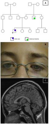 Long-term follow-up of an attenuated presentation of NAXE-related disease, a potentially actionable neurometabolic disease: a case report